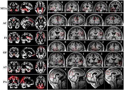 Multiple Visual Rating Scales Based on Structural MRI and a Novel Prediction Model Combining Visual Rating Scales and Age Stratification in the Diagnosis of Alzheimer's Disease in the Chinese Population